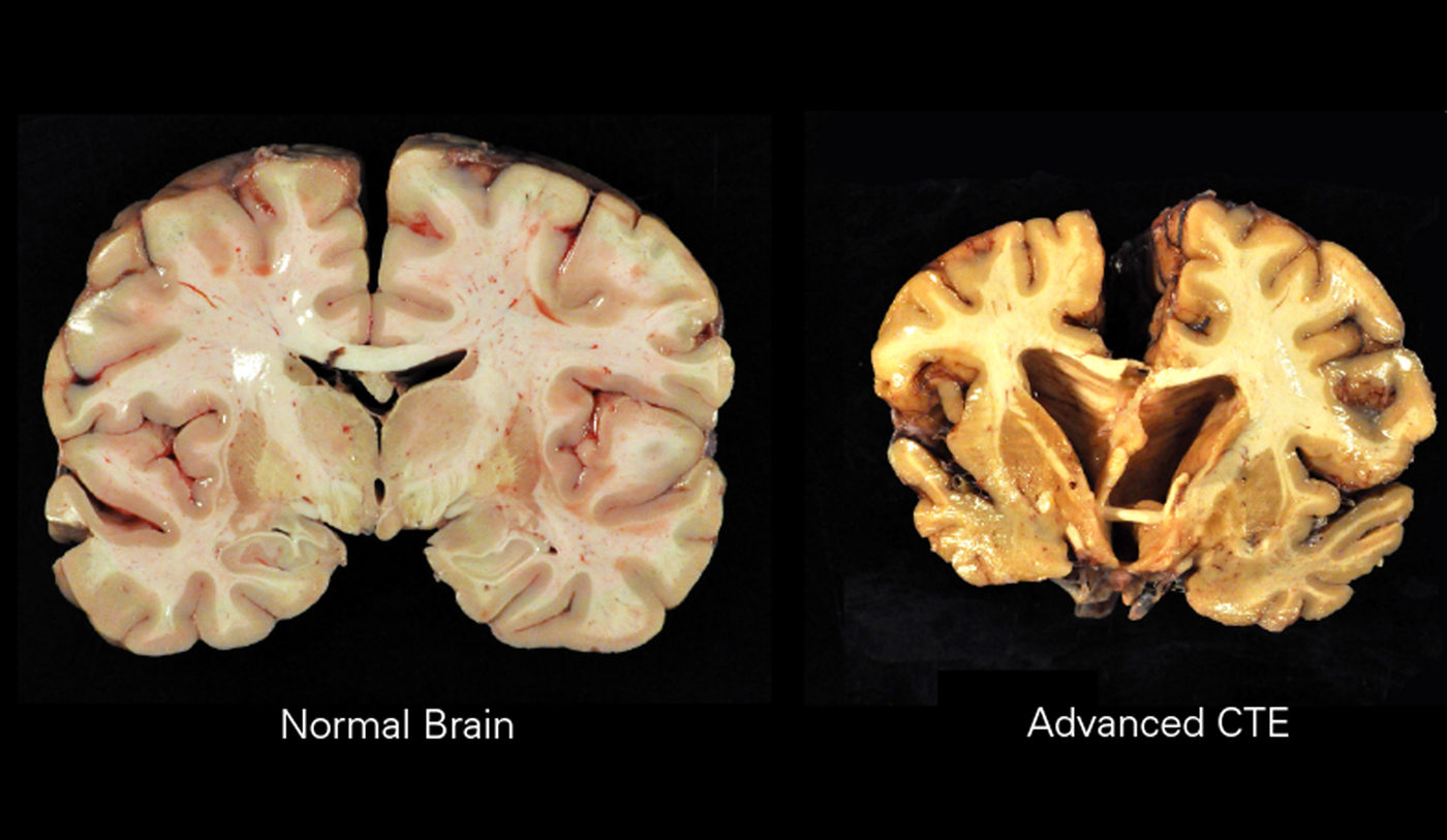 Image showing normal brain and CTE. Credit: By Boston University Center for the Study of Traumatic Encephalopathy [CC BY-SA 4.0 (https://creativecommons.org/licenses/by-sa/4.0)], via Wikimedia Commons.