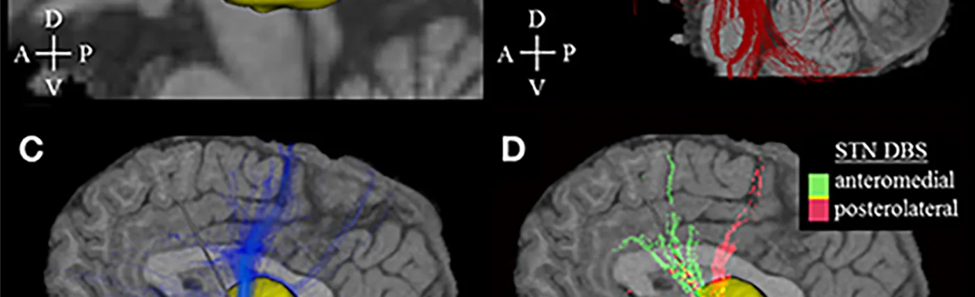 Activation density heat maps showing the electrical deep brain stimulation. Credit: Hartmann CJ, Chaturvedi A and Lujan JL.