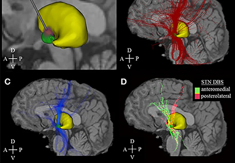 Activation density heat maps showing the electrical deep brain stimulation. Credit: Hartmann CJ, Chaturvedi A and Lujan JL.