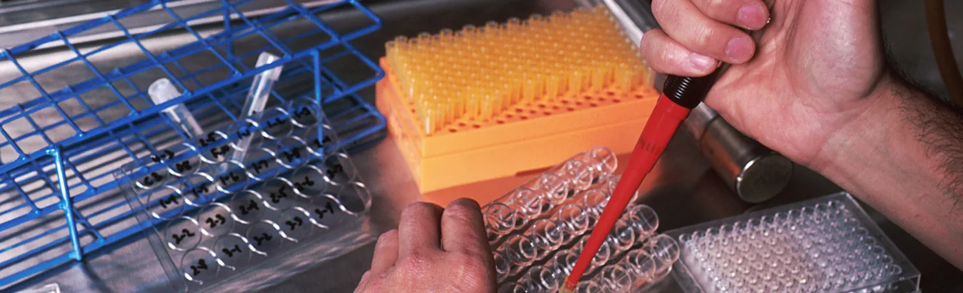 Several shots of a scientist in a laboratory setting, wearing a white coat and performing a test. Only his hands are visible. The scientist is sorting B-cells taken from the bone marrow of a patient with Lupus disease. The Lupus antibody-producing cell is isolated in a well, to be fused with a cancerous mouse myeloma B-cell, producing a hybridoma. Hybridomas produce identical monoclonal antibodies in large quantities and indefinitely.