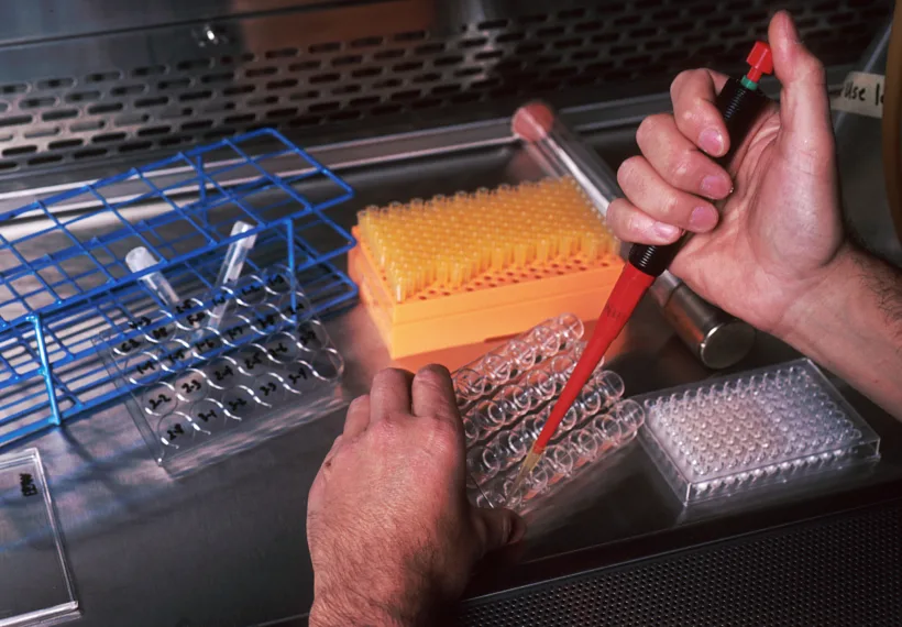 Several shots of a scientist in a laboratory setting, wearing a white coat and performing a test. Only his hands are visible. The scientist is sorting B-cells taken from the bone marrow of a patient with Lupus disease. The Lupus antibody-producing cell is isolated in a well, to be fused with a cancerous mouse myeloma B-cell, producing a hybridoma. Hybridomas produce identical monoclonal antibodies in large quantities and indefinitely.