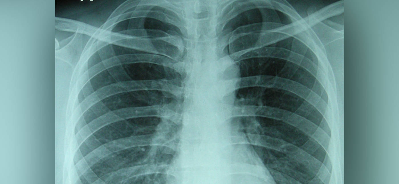 The chest X-ray photo of a 30-years-old healthy man.