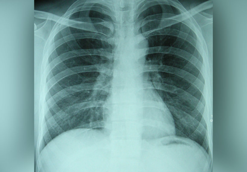 The chest X-ray photo of a 30-years-old healthy man.