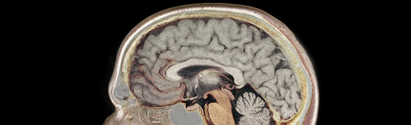 MR-Scan_of_Garpenholms_Brain