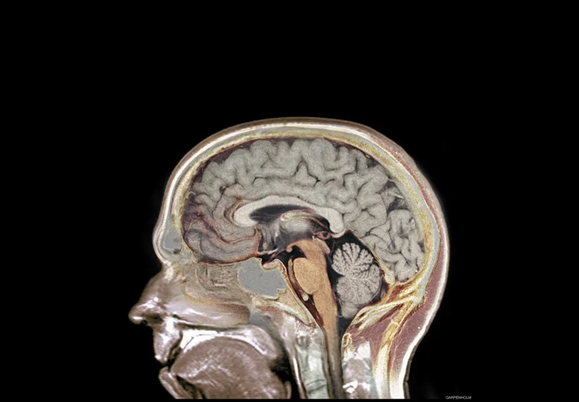 MR-Scan_of_Garpenholms_Brain