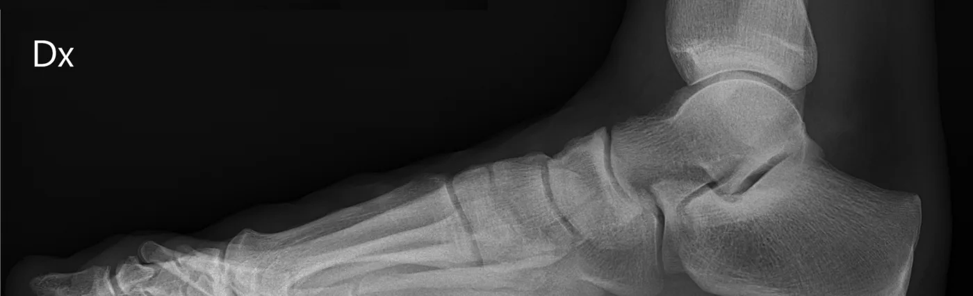X-ray (projectional radiograph) of a normal right foot of a 31 year old male, by lateral projection. It is a weightbearing image, standing on the imaged foot on a soft material.