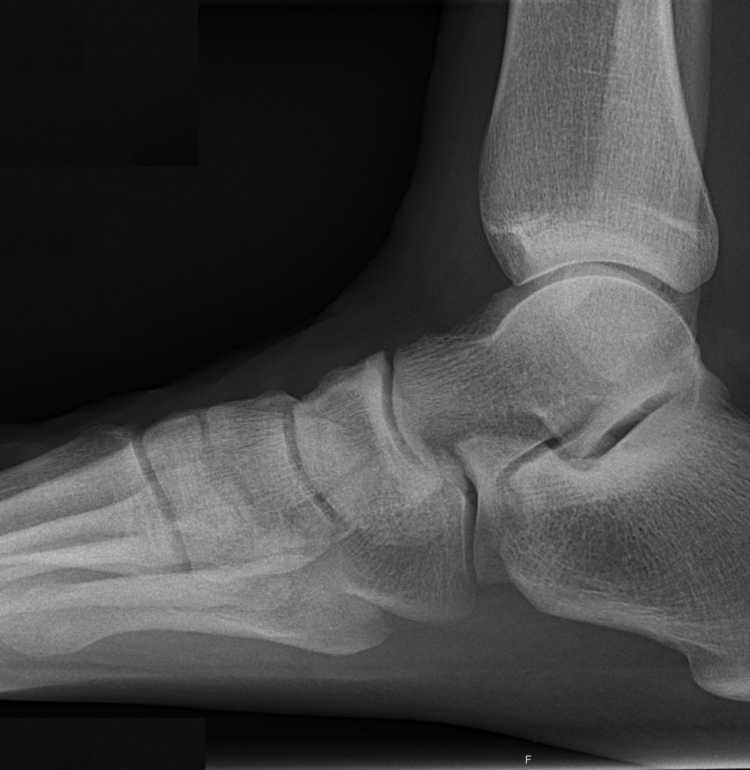 X-ray (projectional radiograph) of a normal right foot of a 31 year old male, by lateral projection. It is a weightbearing image, standing on the imaged foot on a soft material.