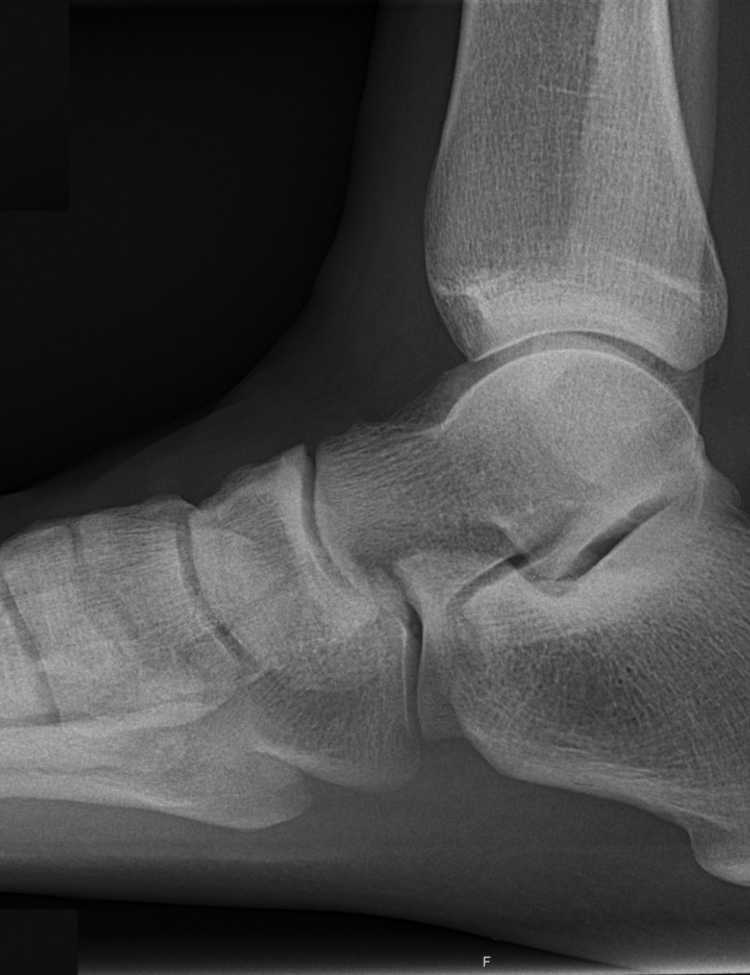X-ray (projectional radiograph) of a normal right foot of a 31 year old male, by lateral projection. It is a weightbearing image, standing on the imaged foot on a soft material.