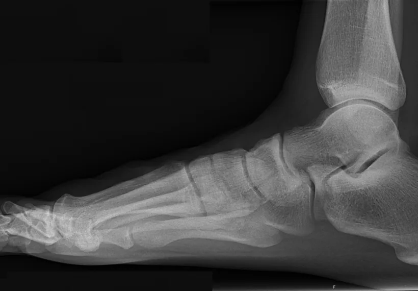 X-ray (projectional radiograph) of a normal right foot of a 31 year old male, by lateral projection. It is a weightbearing image, standing on the imaged foot on a soft material.
