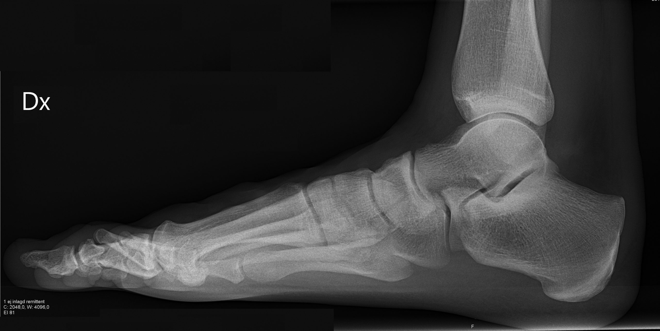 https://startalkmedia.com/wp-content/uploads/2022/09/X-ray_of_normal_right_foot_by_lateral_projection-scaled.jpeg