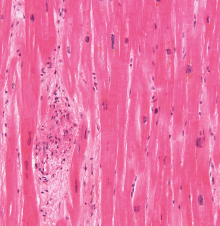High magnification micrograph of rheumatic heart disease.