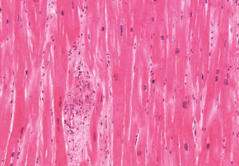 High magnification micrograph of rheumatic heart disease.