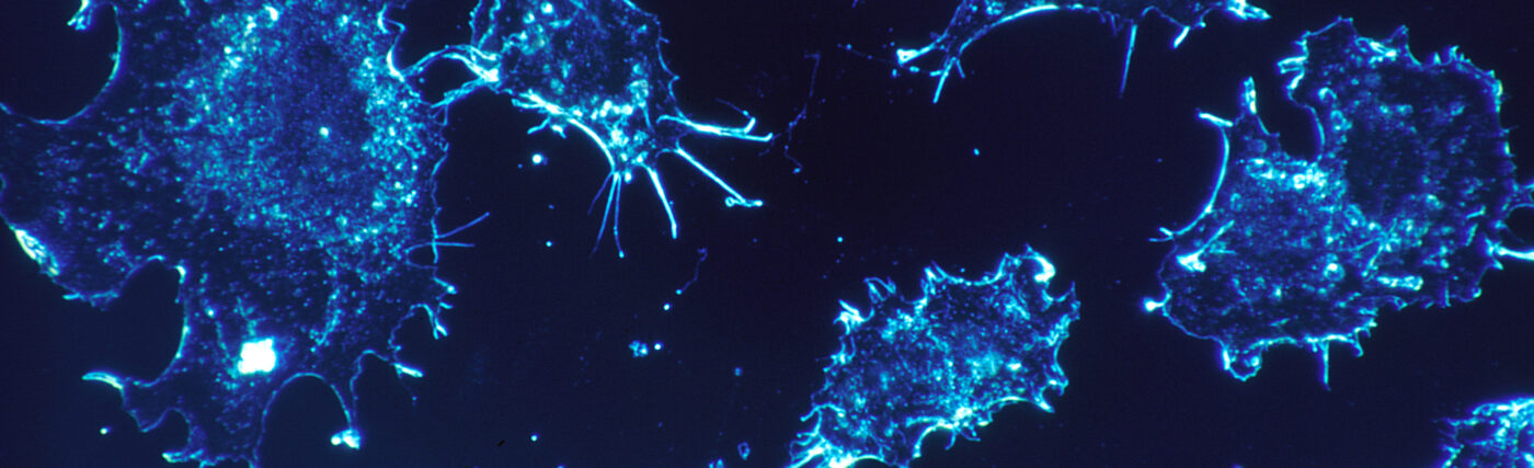 Cancer cells in culture from human connective tissue, illuminated by darkfield amplified contrast, at a magnification of 500x.