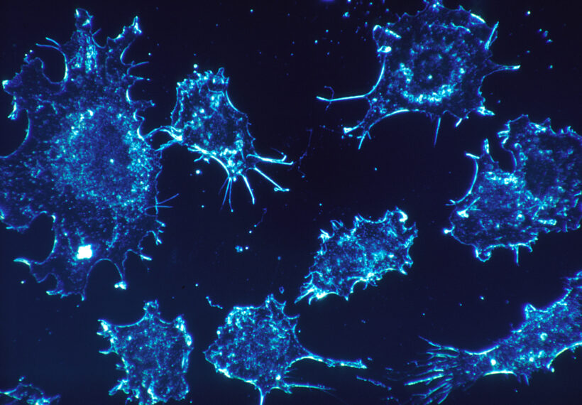 Cancer cells in culture from human connective tissue, illuminated by darkfield amplified contrast, at a magnification of 500x.