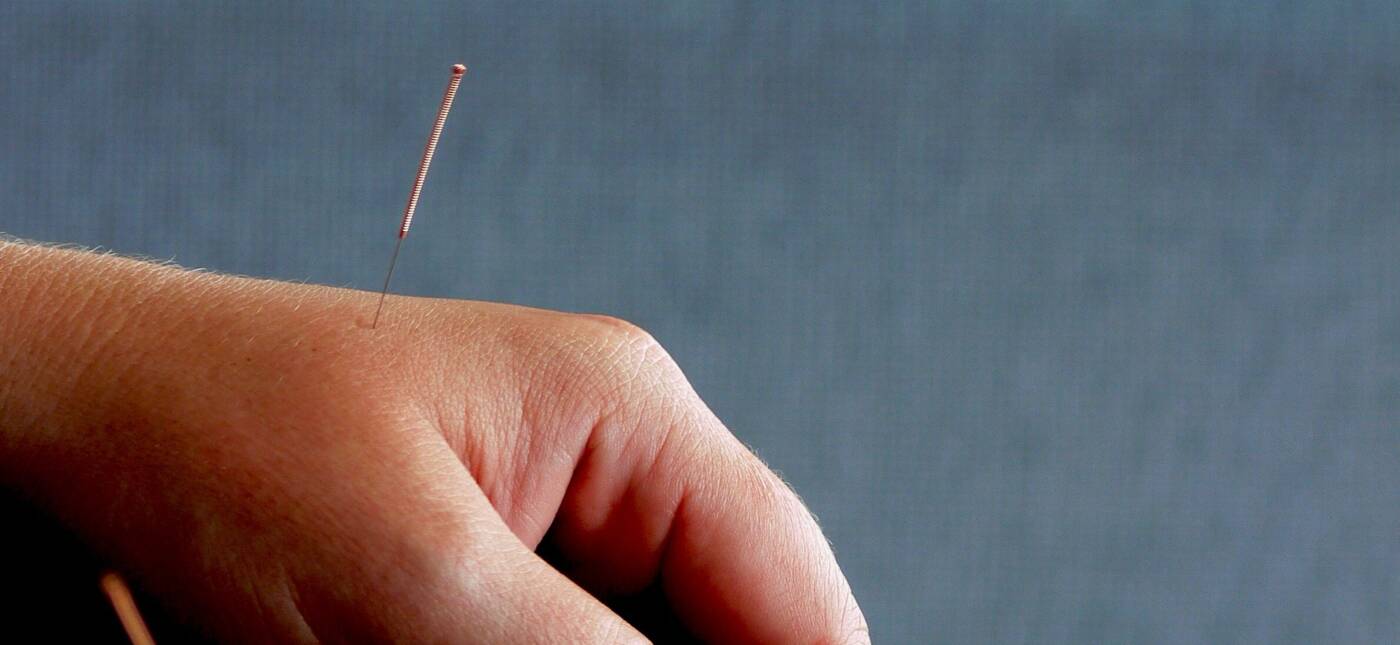 Pair of human hands with acupuncture needles