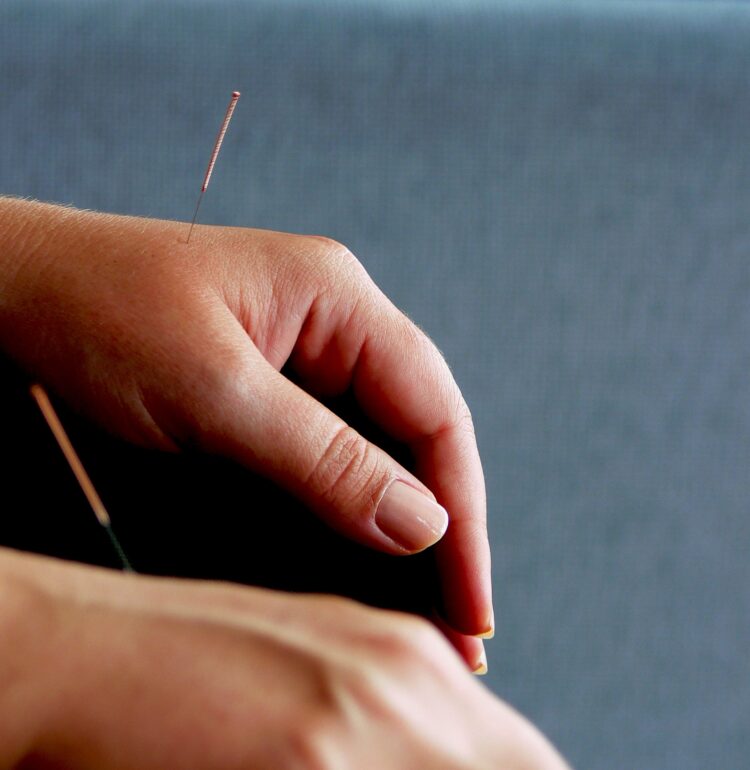 Pair of human hands with acupuncture needles
