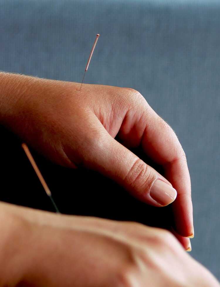 Pair of human hands with acupuncture needles