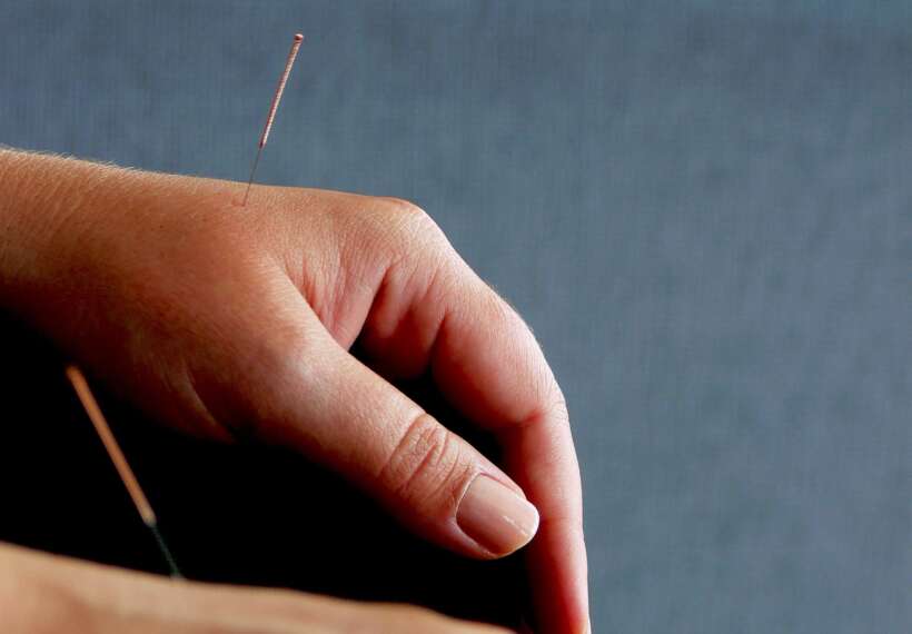 Pair of human hands with acupuncture needles
