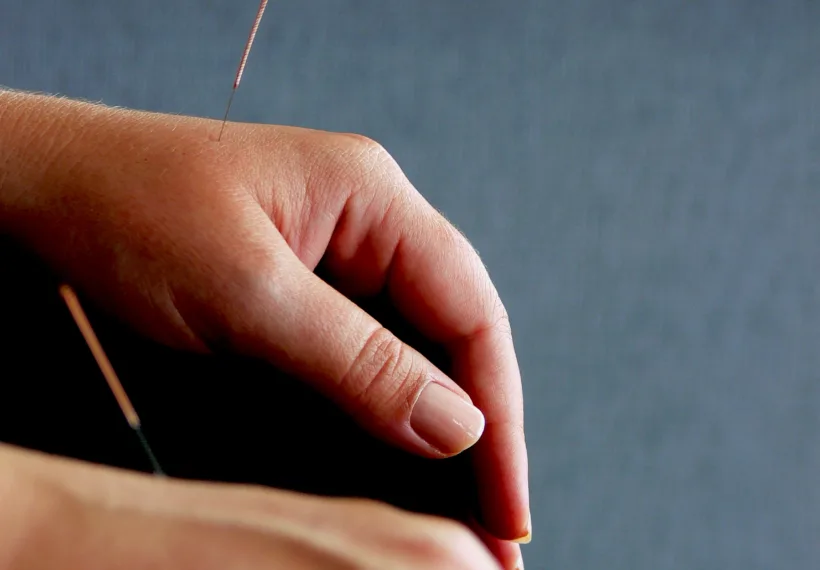Pair of human hands with acupuncture needles